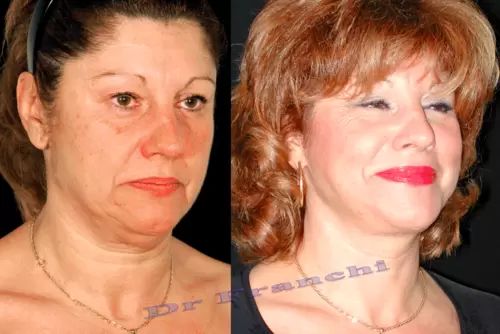 Convalescence d'un lifting du visage