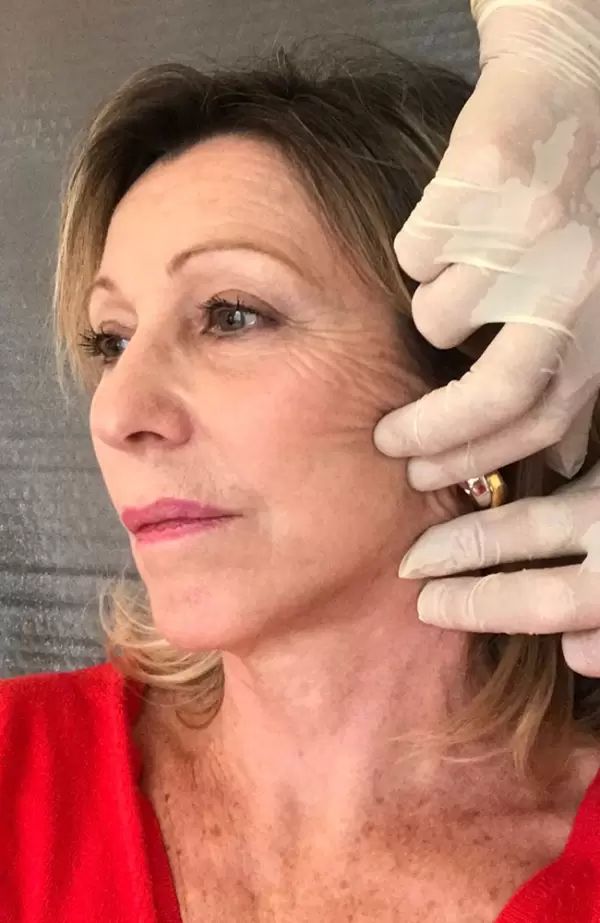 13 Manoeuvre reproduisant Lifting Cervico facial