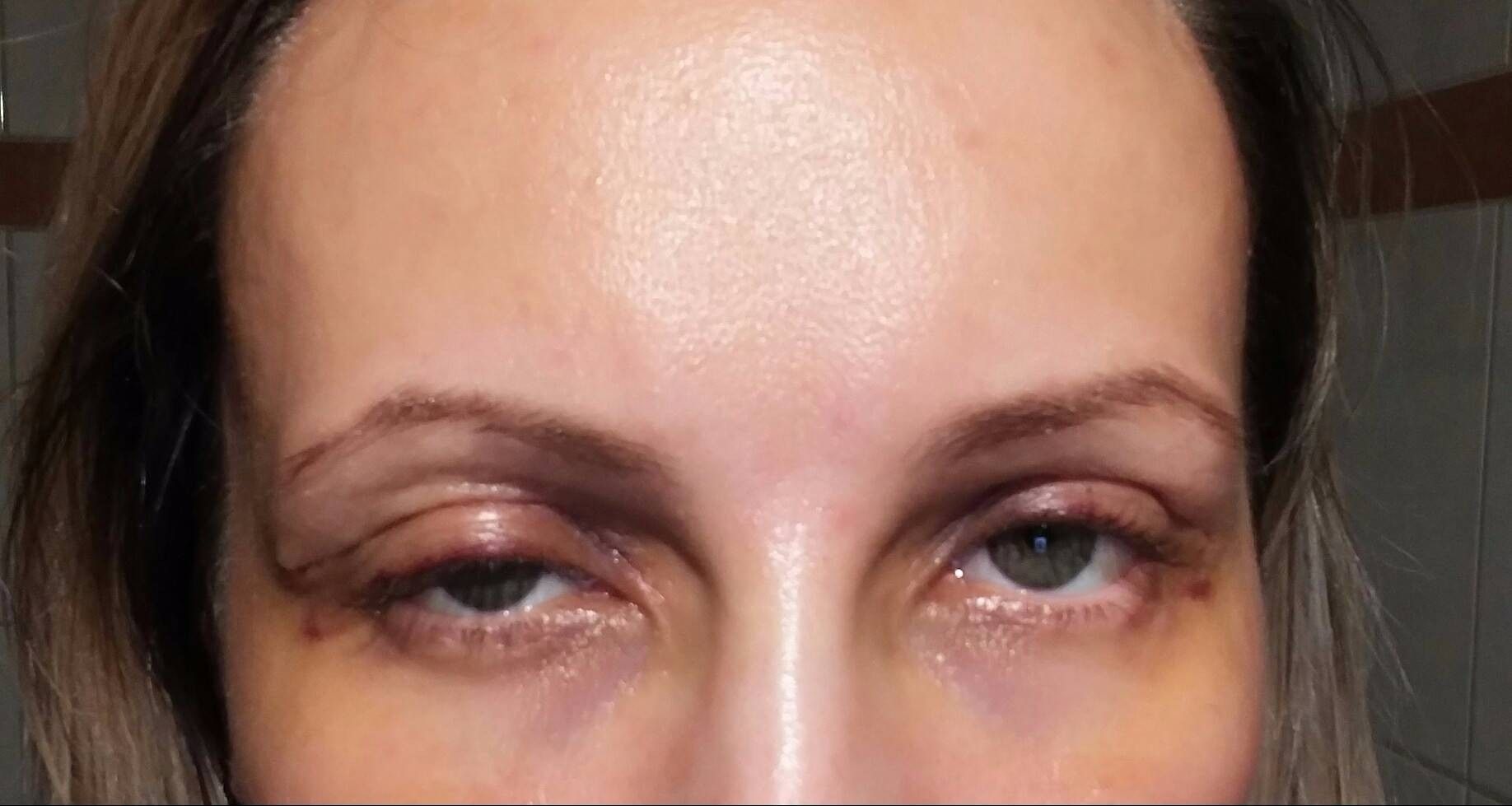 Plastyka Powiek Górnych Korekcja Powiek Blepharoplastyka Forum Estheticonpl 9774