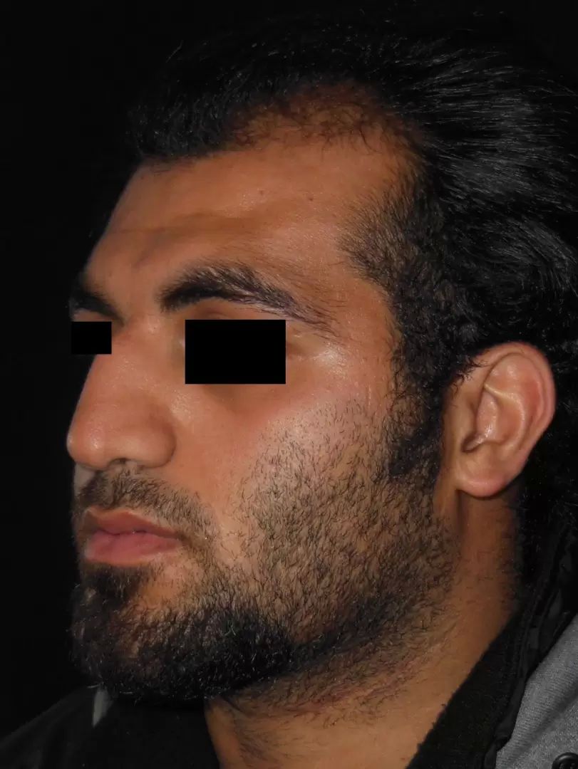 avant feminisation visage