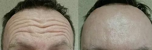 botox1