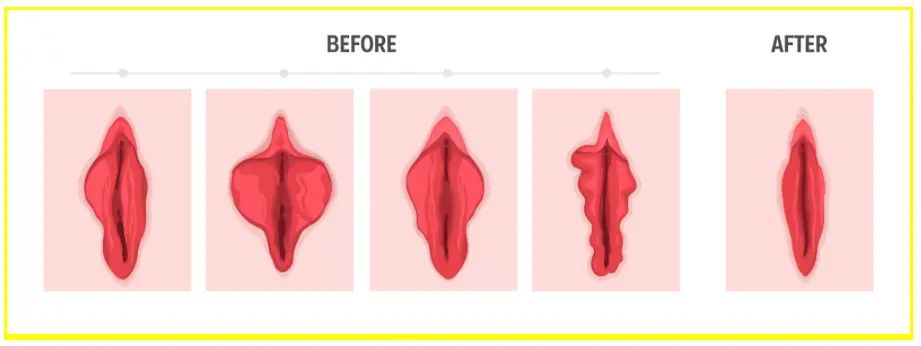 vaginastraffung