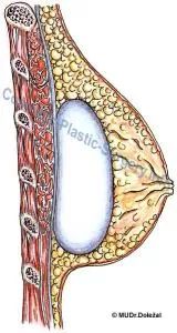 prsni implantat