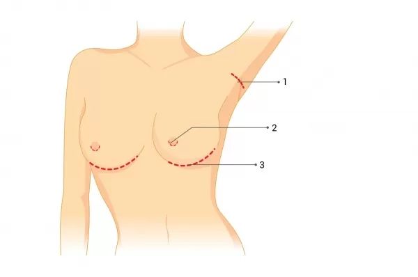 Möglichkeiten der Implantatlage