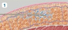 liposukce3