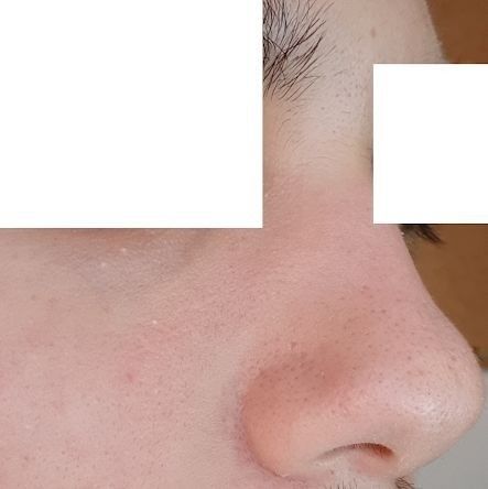 Verkleinerung Der Nasenspitze Nasenkorrektur Rhinoplastik Forum Estheticon De