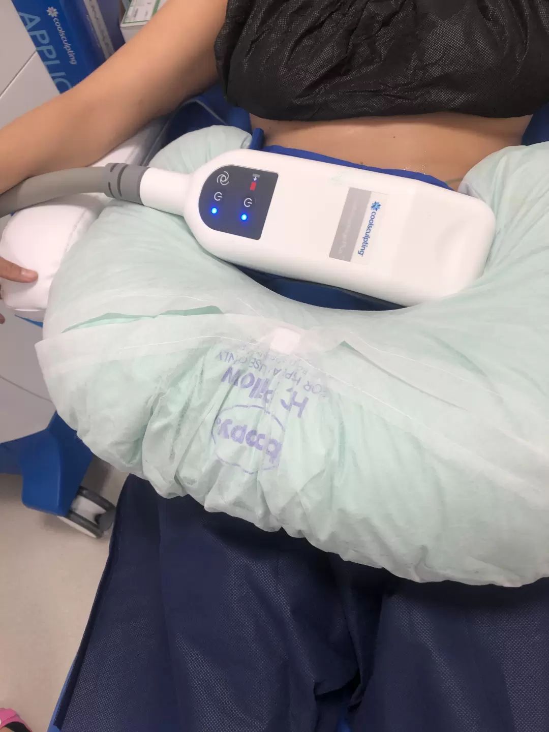 1 cyklus - nasatie brucha pri Kryolipolýze Coolsculpting