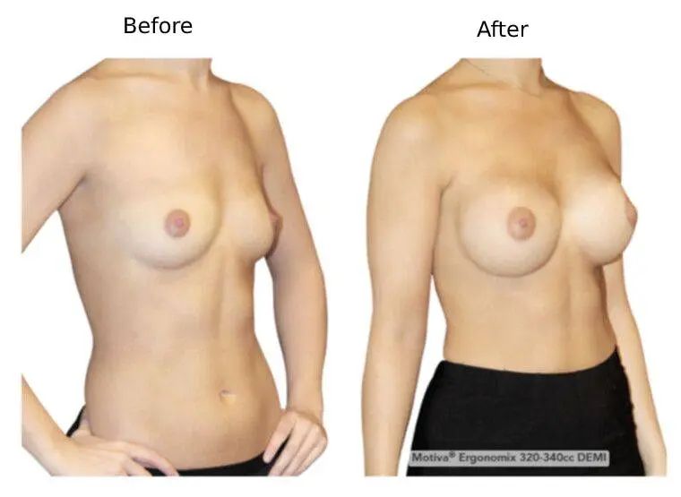 motiva ergonomix before after (1)