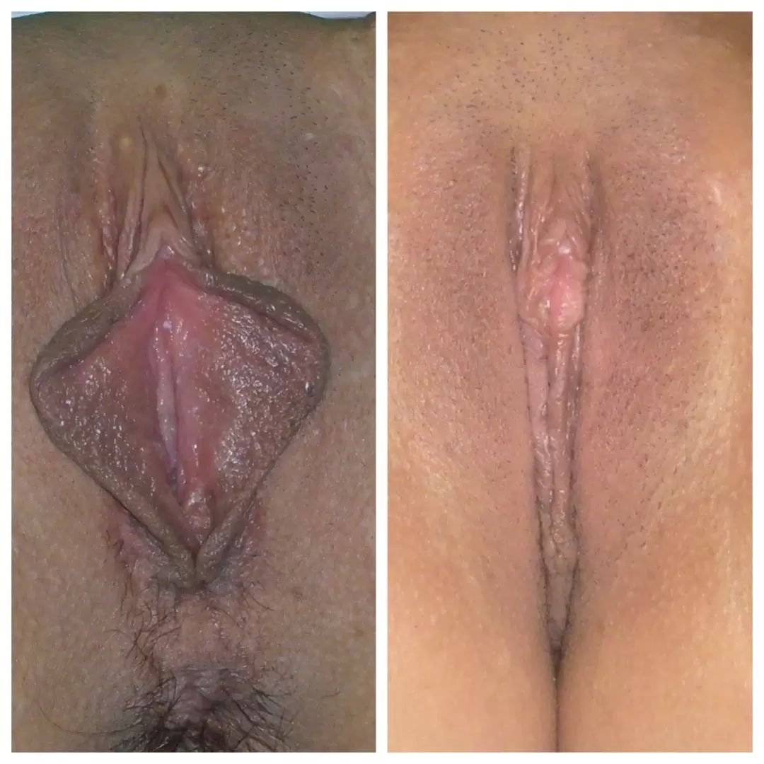 antes y después vaginoplastia