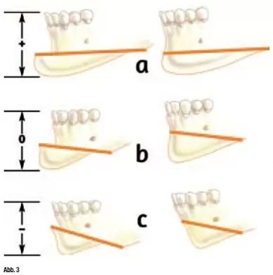 genioplastik3