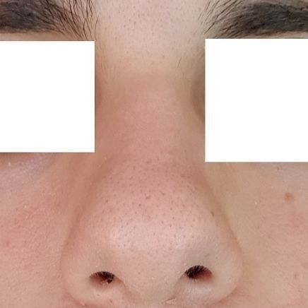 Verkleinerung Der Nasenspitze Nasenkorrektur Rhinoplastik Forum Estheticon De