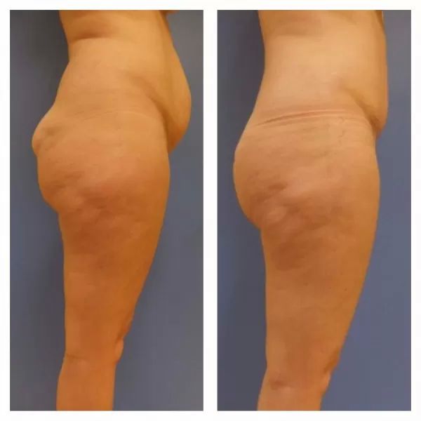 abdominoplastic3