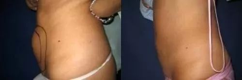 neinvazivní liposukce kavitace