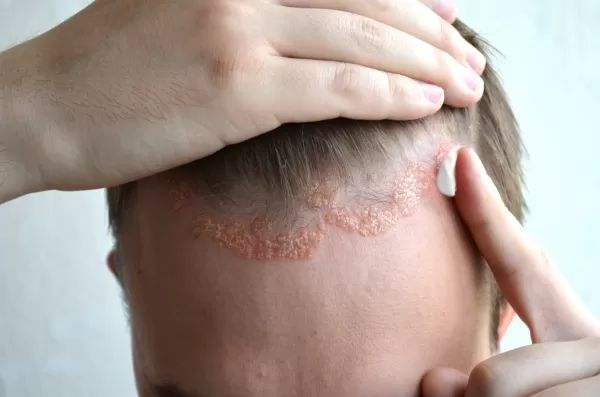 lupénka (psoriaza)