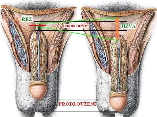 náčrtek toho, kudy je vedený řez při chirurgickém zvětšení penisu