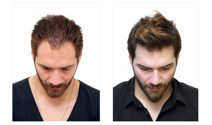 Criteria to Choose the Best Hair Transplant Clinic in India