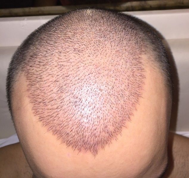 Haartransplantation 4000 Grafts Sehr Zufrieden Mit Dem Resultat Estheticon De