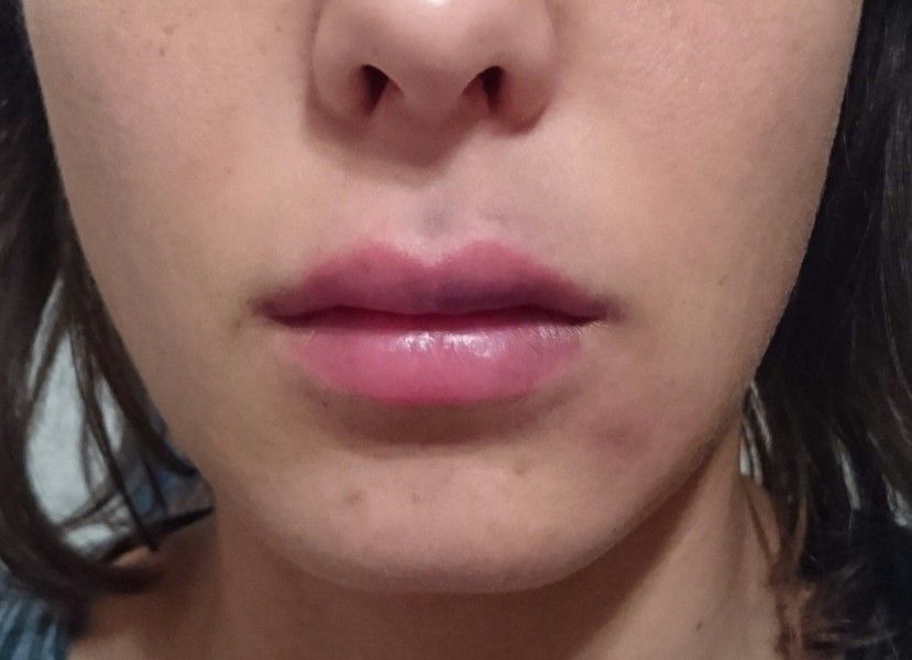 Zu Grosse Oberlippe Lippenaufspritzen Mit 0 8 Ml Lippenvergrosserung Mit Hyaluronsaure Forum Estheticon De