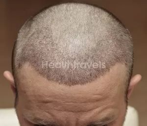 "haartransplantation