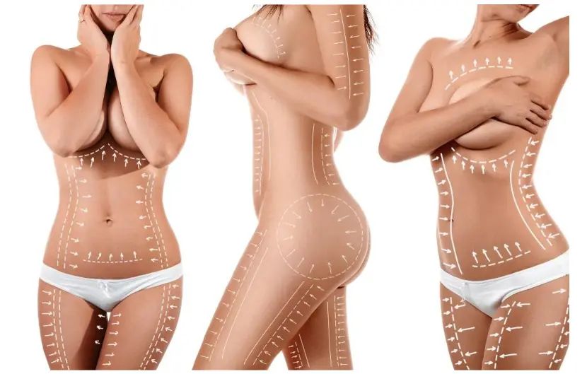 liposuktion 3