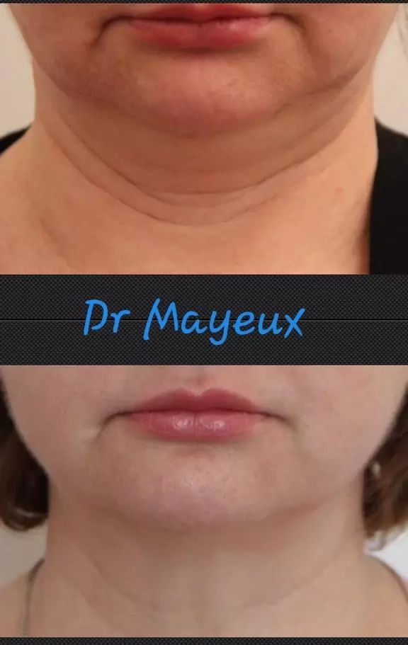 photo cryolipolyse Double menton face