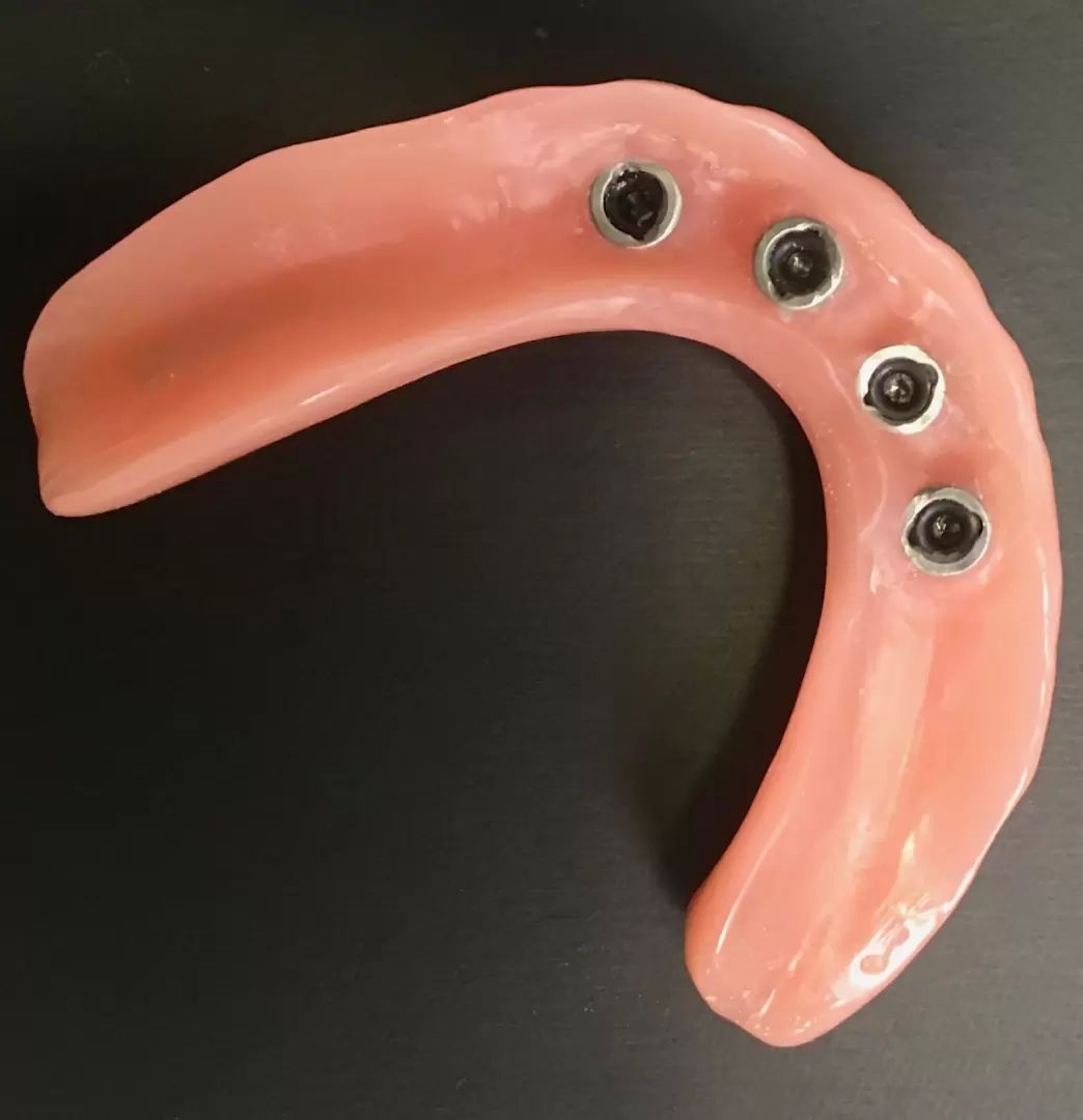 Housingy, zubné miniimplantáty