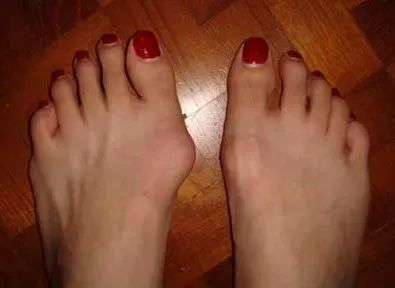 hallux valgus