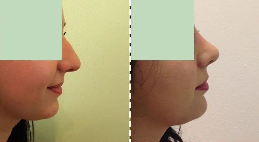 RhinoplastyMotruc (2)