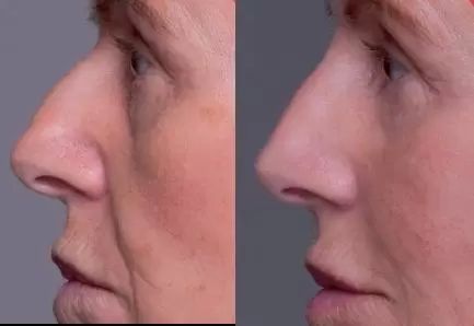 Dermacentrum plus Pred a po NOS