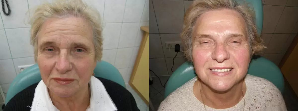 Sciborowicz botox