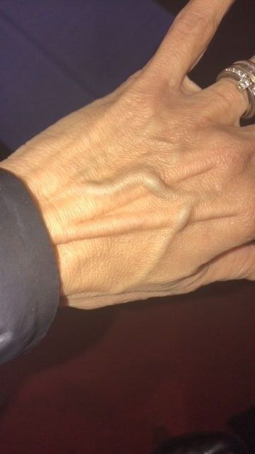 vene evidenti capezzoli
