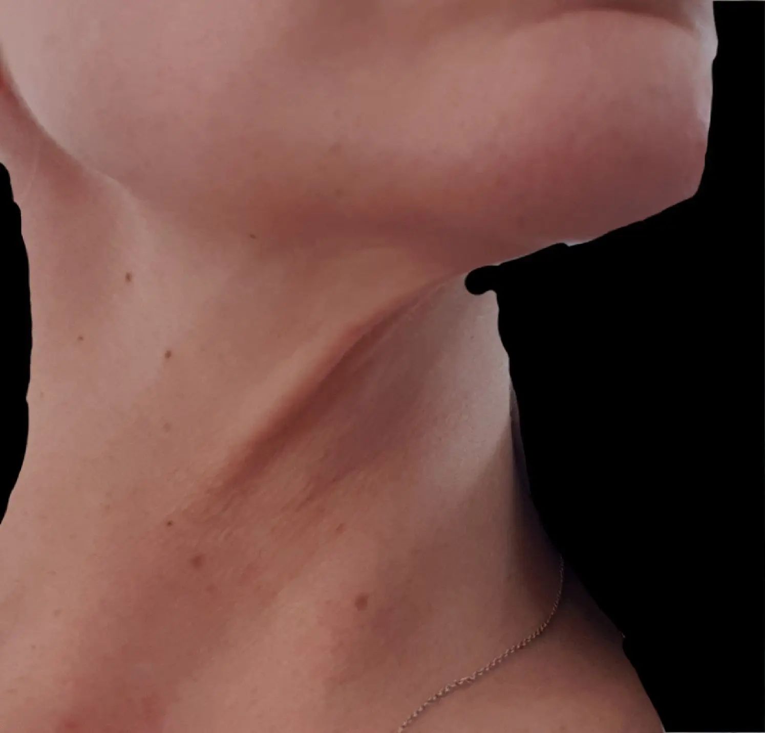 Kinn Hals Linie Straffen Halslifting Forum Estheticon De