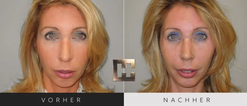 nase huemer 1