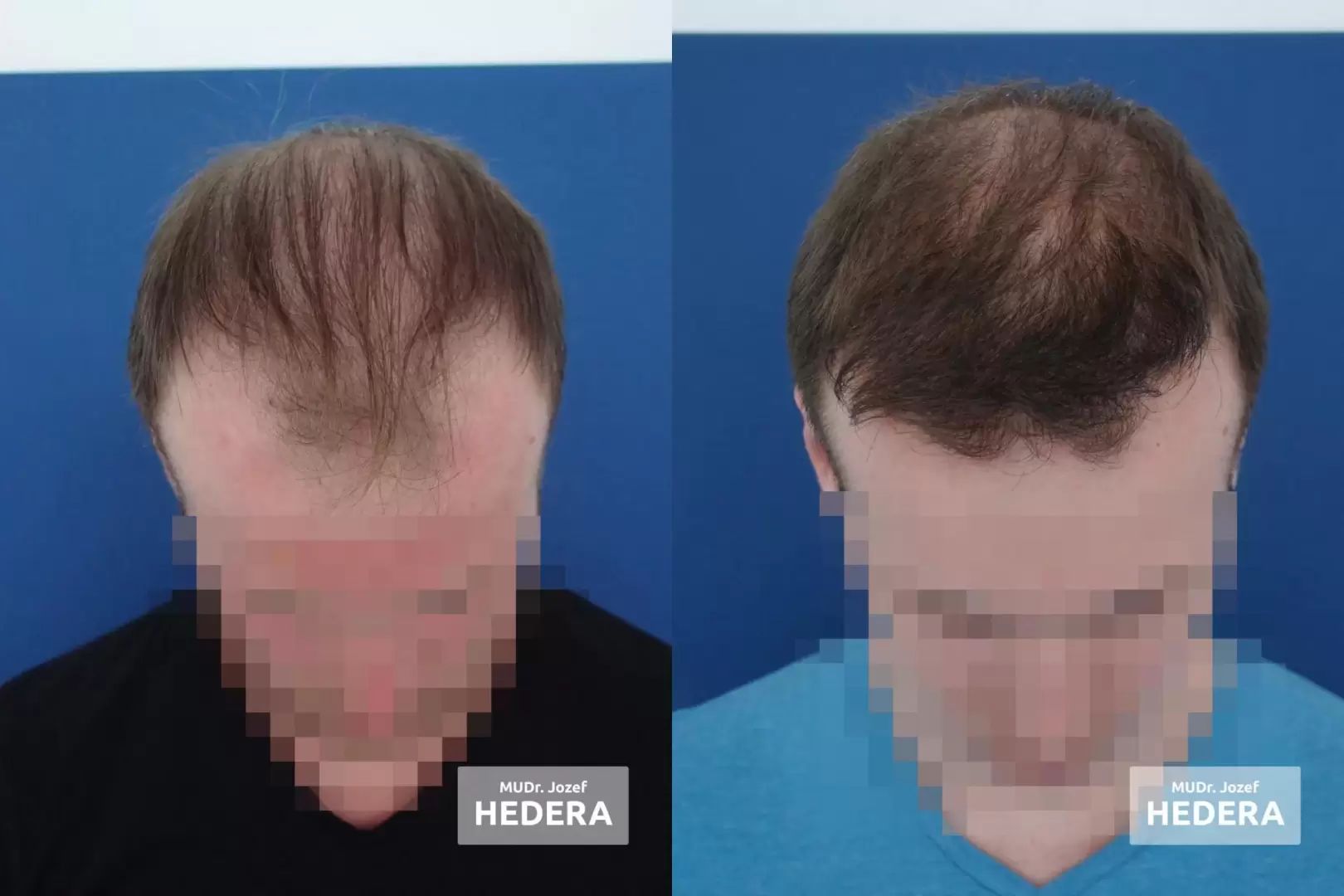 Pred po fotky po nastrelení, transplantácii vlasov