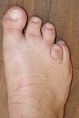 brachymetatarsie1
