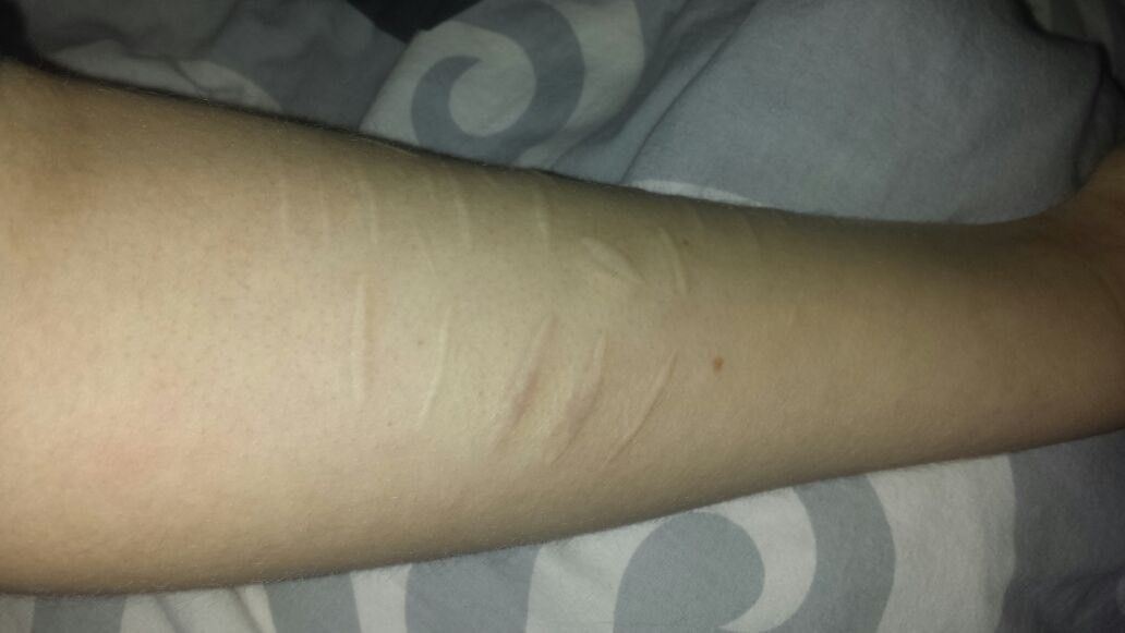 Korrektru der SVVNarben Narbenkorrektion Forum Estheticon.de