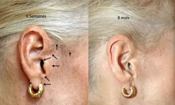 15 Cicatrices lifting Cervico facial avant