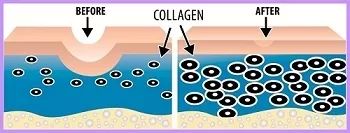 Microneedling3