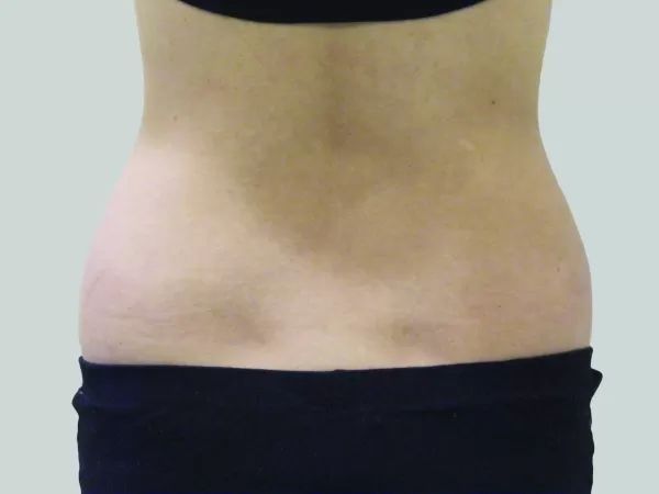 Exilis Elite PIC B&A 011 After