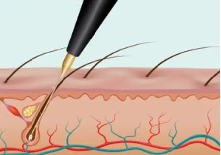 epilation