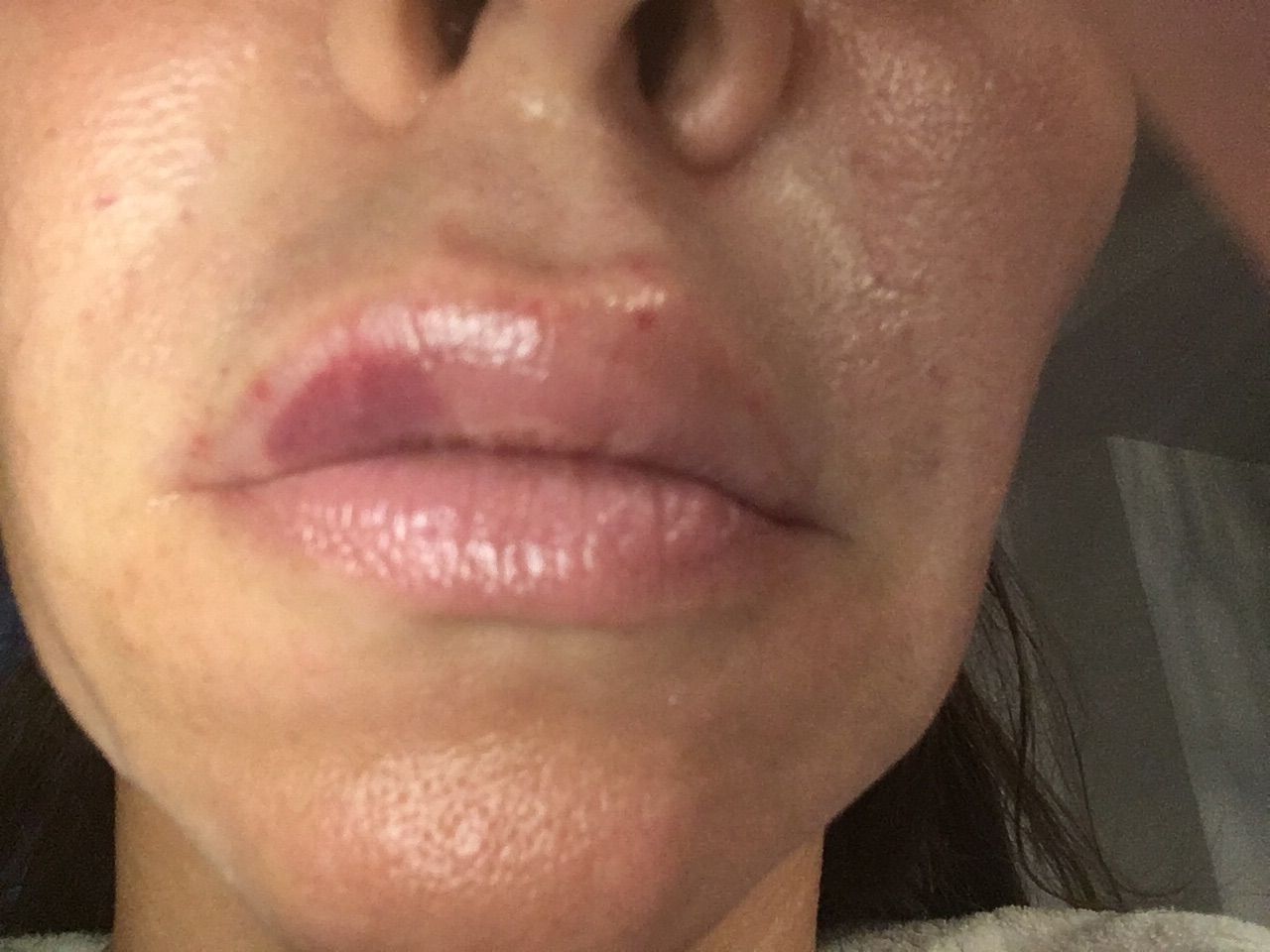 Extreme Schwellung Nach Lippen Aufspritzen Injizierbare Fullstoffe Dysport Restylane Botox Bio Alcamid Forum Estheticon De