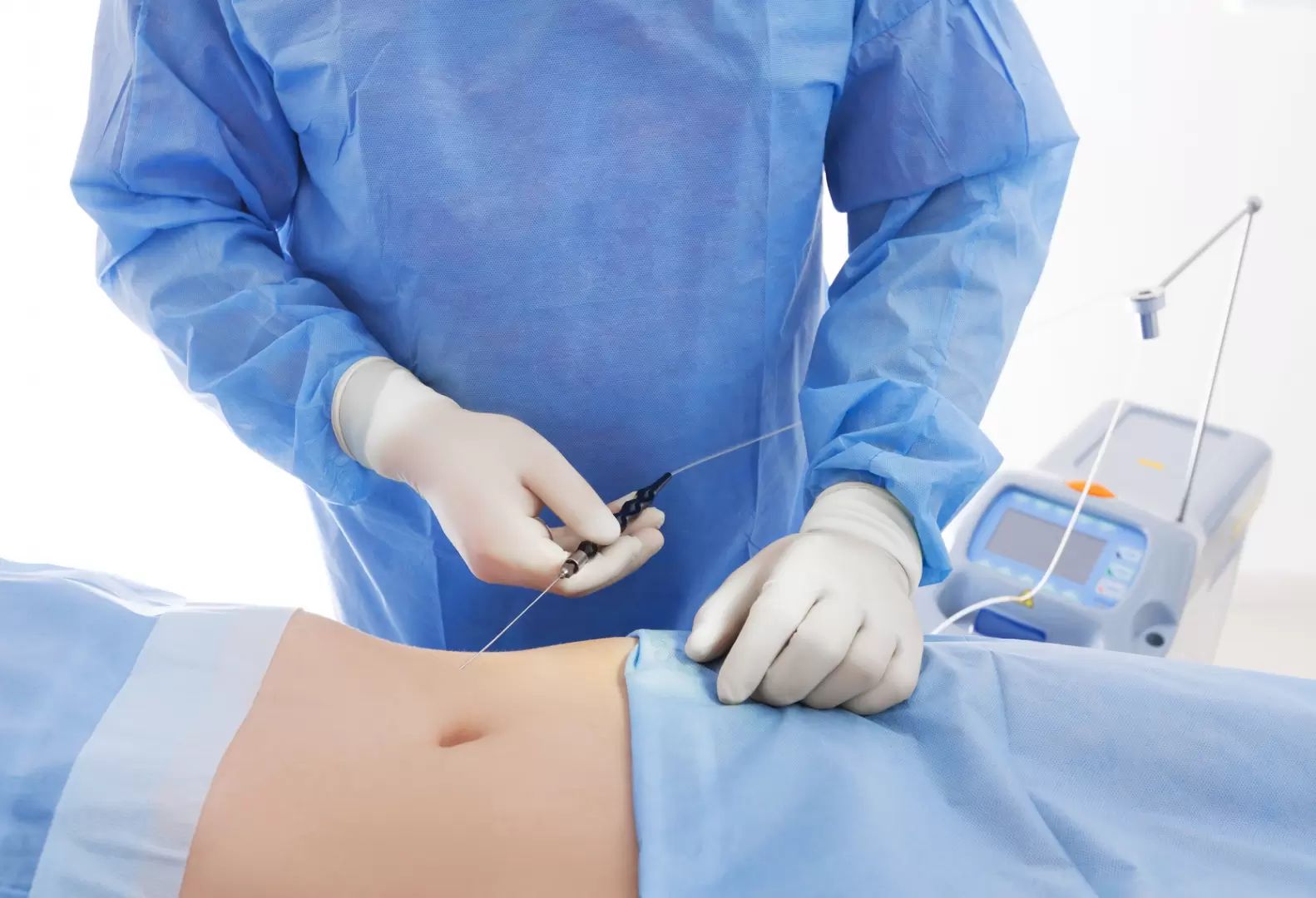 odsátí tuků pomocí laserové liposukce