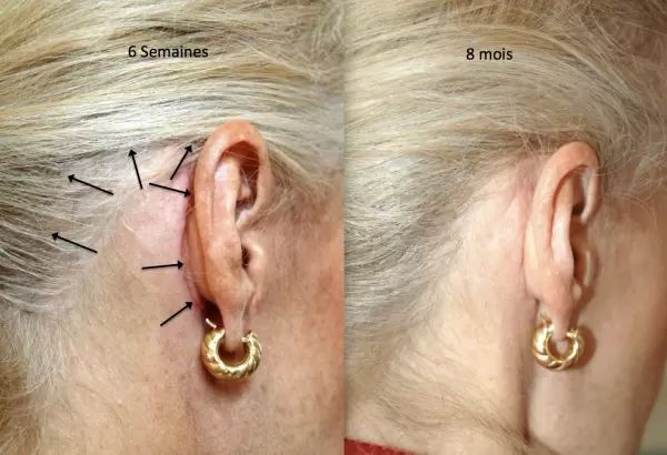 16 Cicatrices Lifting cervico facial arrière