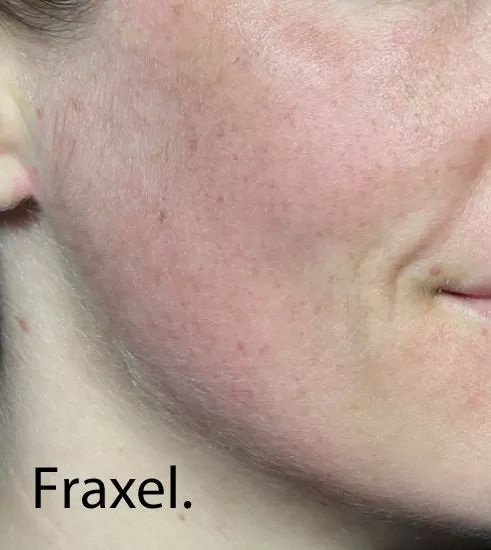 1 Fraxel