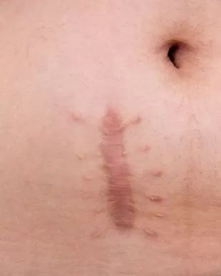 cicatrice laser