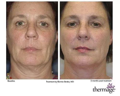 thermage2