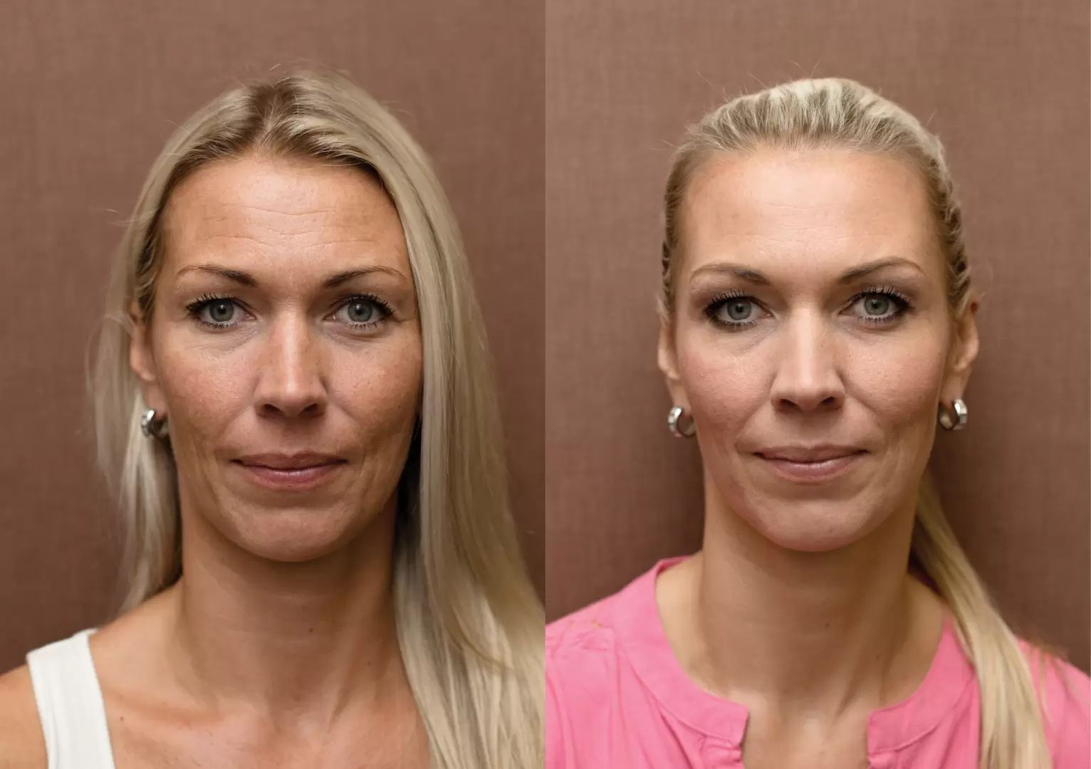 chemicky peeling, skinbooster, plasmaterapie, botolutoxin, odstranění vrásek