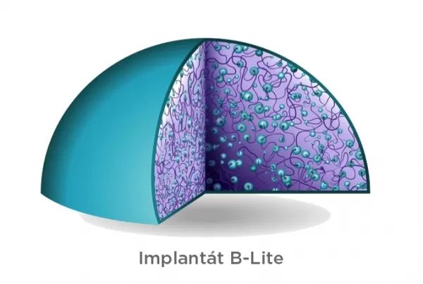 B Lite implantat