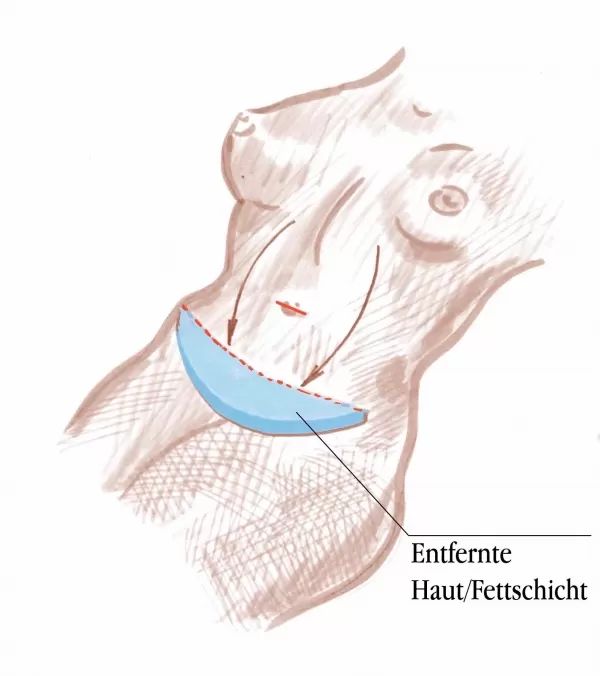Hautlappenentfernung bei Bauchstraffung