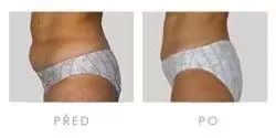 fotky před a po SlimLipo laserové liposukci